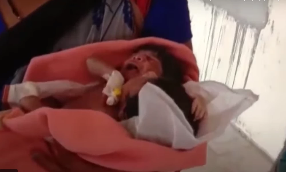 Μωρό στην Ινδία γεννήθηκε με δύο κεφάλια και τρία χέρια